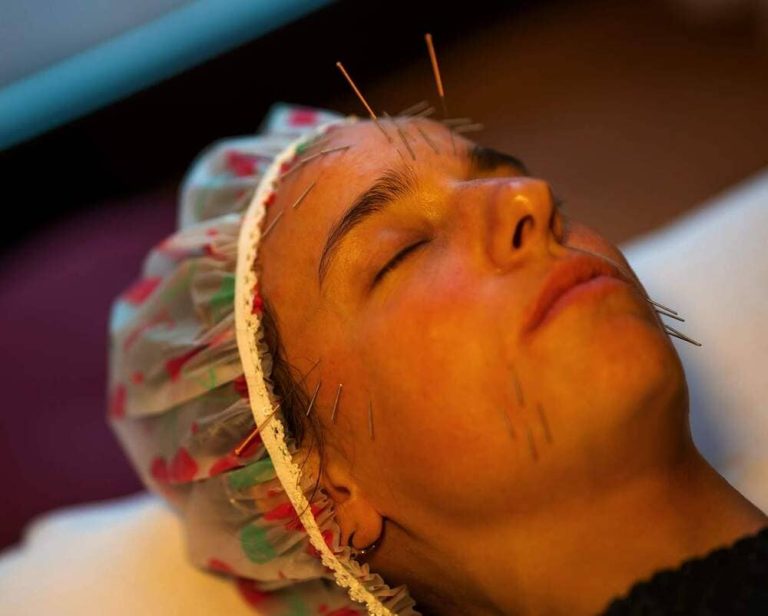 Acupuntura en la cara de una mujer