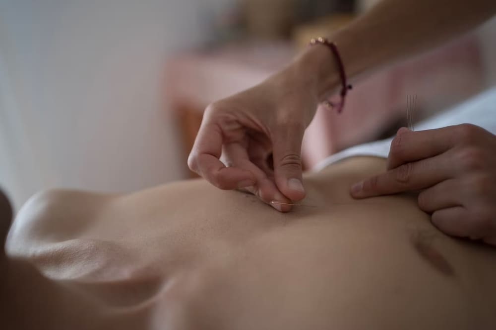 Una persona poniendo agujas de acupuntura en el pecho de un hombre