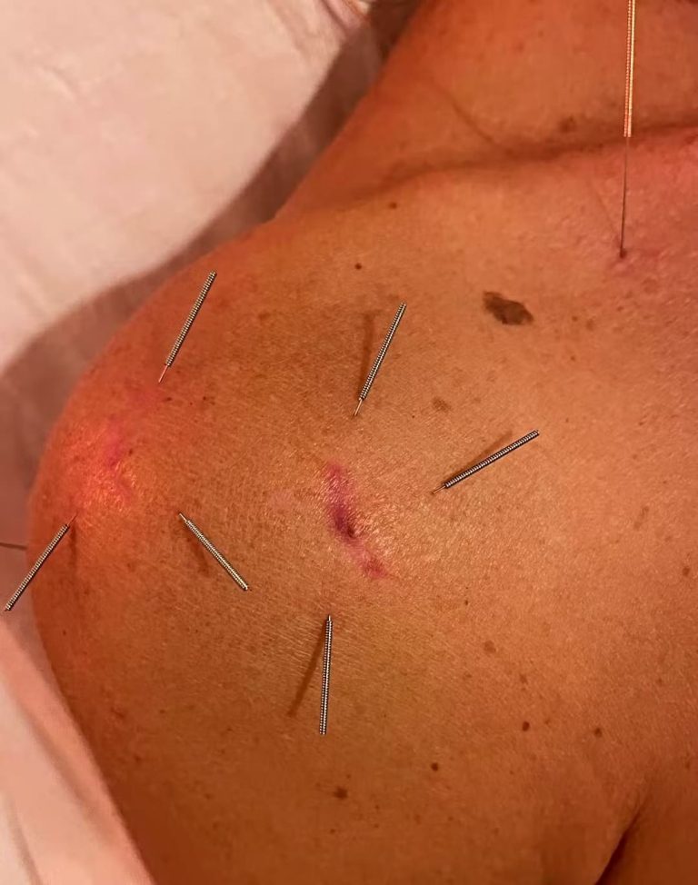 Hombro con agujas de acupuntura