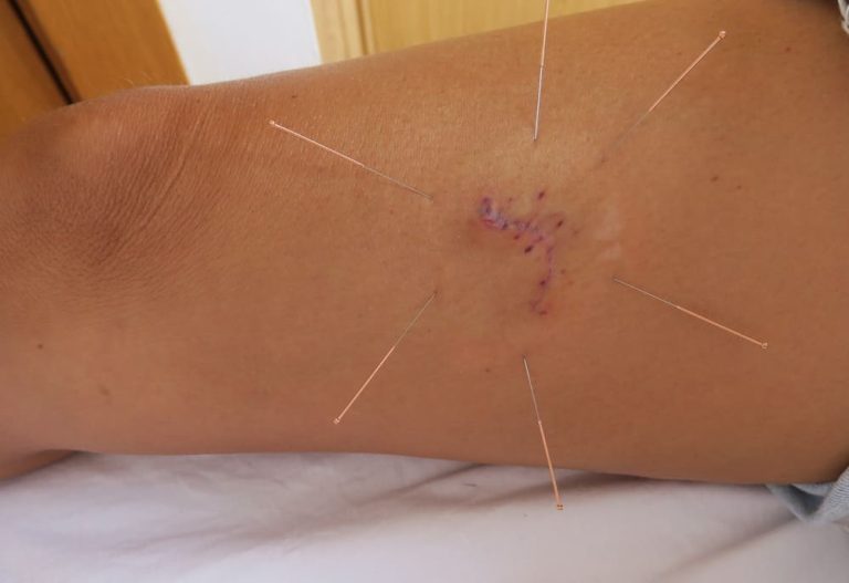 Acupuntura en una cicatriz en la pierna