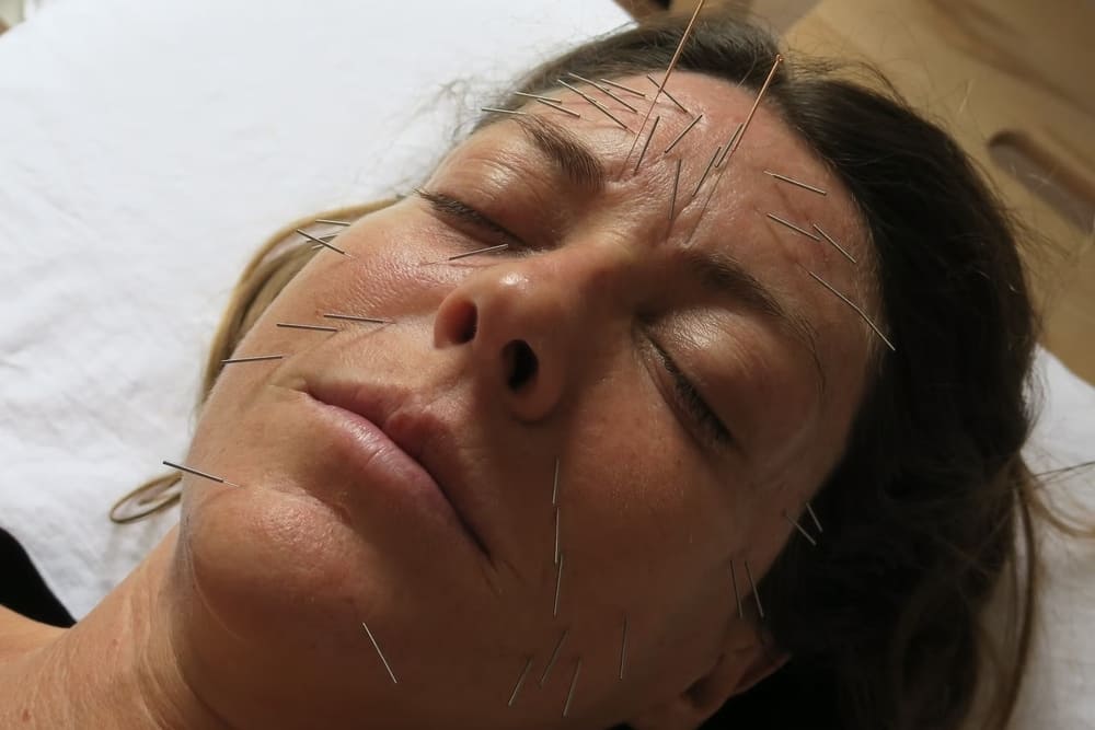 Acupuntura en una cara