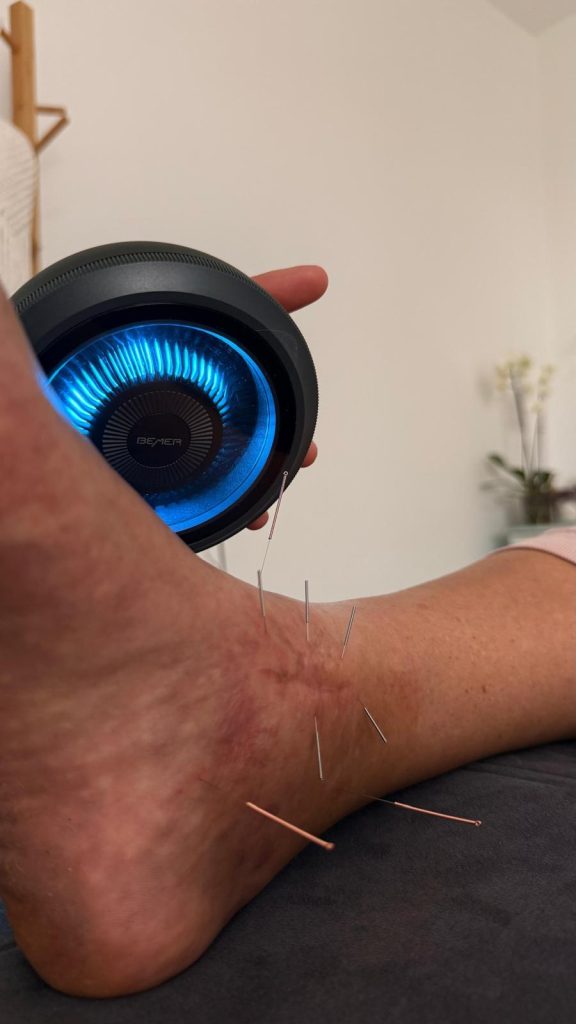 Tratamiento de acupuntura deportiva combinado con Terapia Bemer en Fuerteventura